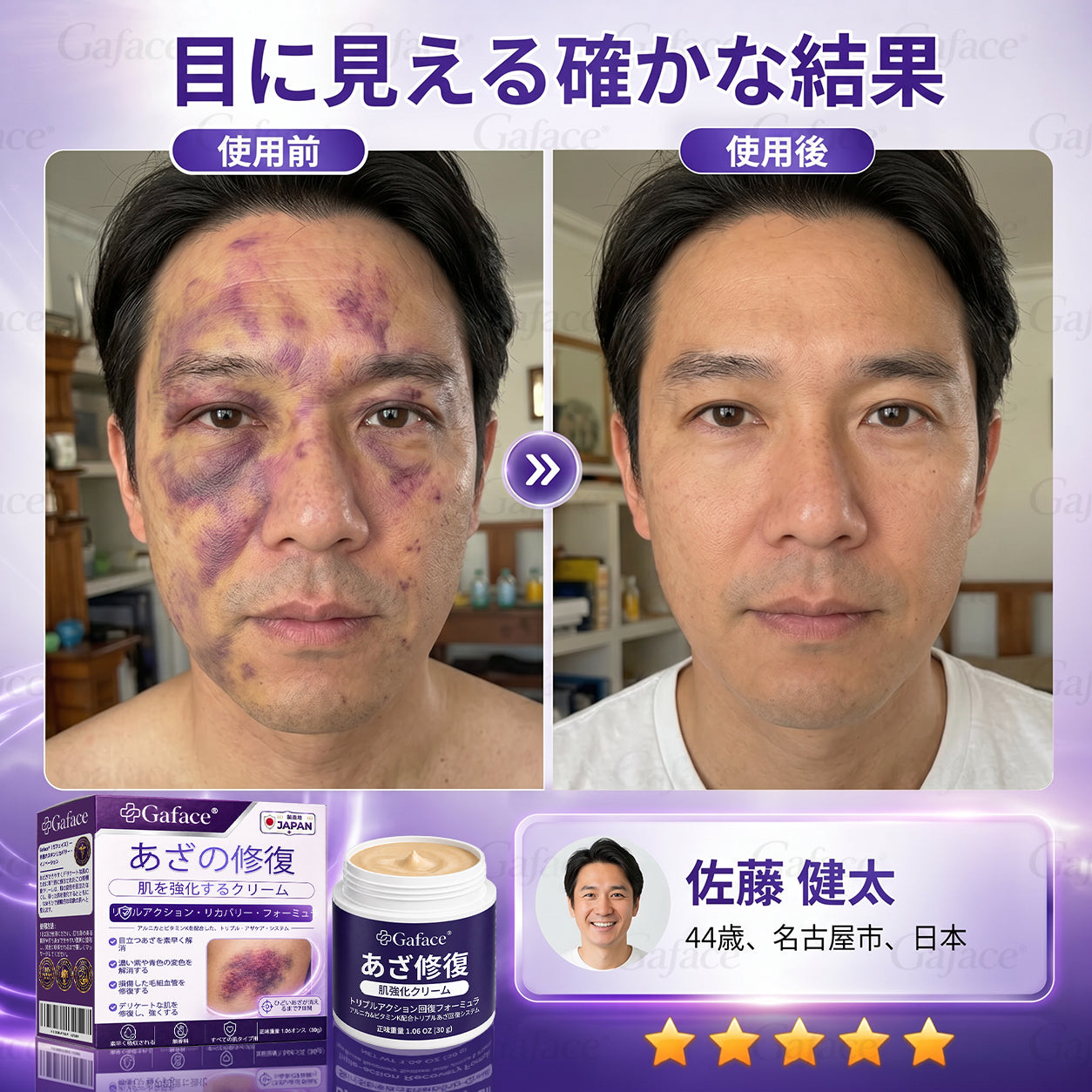 [販売数𝟏𝟏万個以上] 👩‍⚕️☑️𝐆𝐚𝐟𝐚𝐜𝐞®打撲ケア肌強化クリ一ム