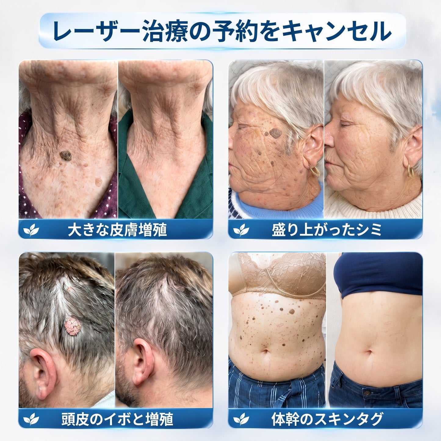 🌼公式ブランドストア  𝐏i𝐜𝐝o® 𝟕日間イボ&シミ消し(痛みも傷跡もゼロのローラーボール)
