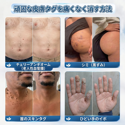 🌼公式ブランドストア  𝐏i𝐜𝐝o® 𝟕日間イボ&シミ消し(痛みも傷跡もゼロのローラーボール)